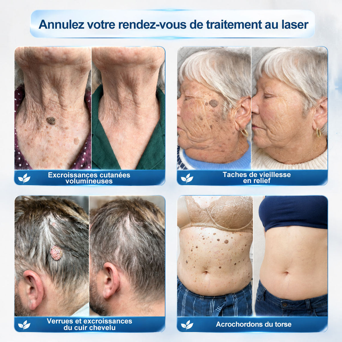 Boutique officielle de la marque |✅🚀𝐏i𝐜𝐝o® 7 Jours Effaceur de taches et d’excroissances cutanées(Zéro douleur, zéro cicatrice – Roller)