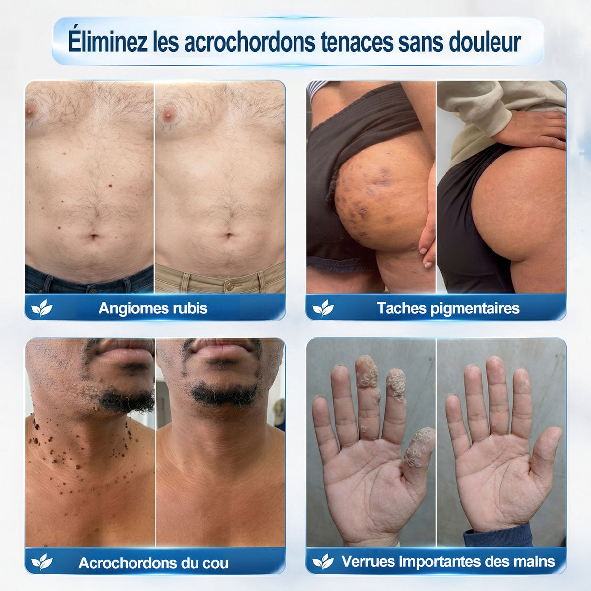 Boutique officielle de la marque |✅💎𝐏i𝐜𝐝o® 7 Jours Effaceur de taches et d’excroissances cutanées(Zéro douleur, zéro cicatrice – Roller)