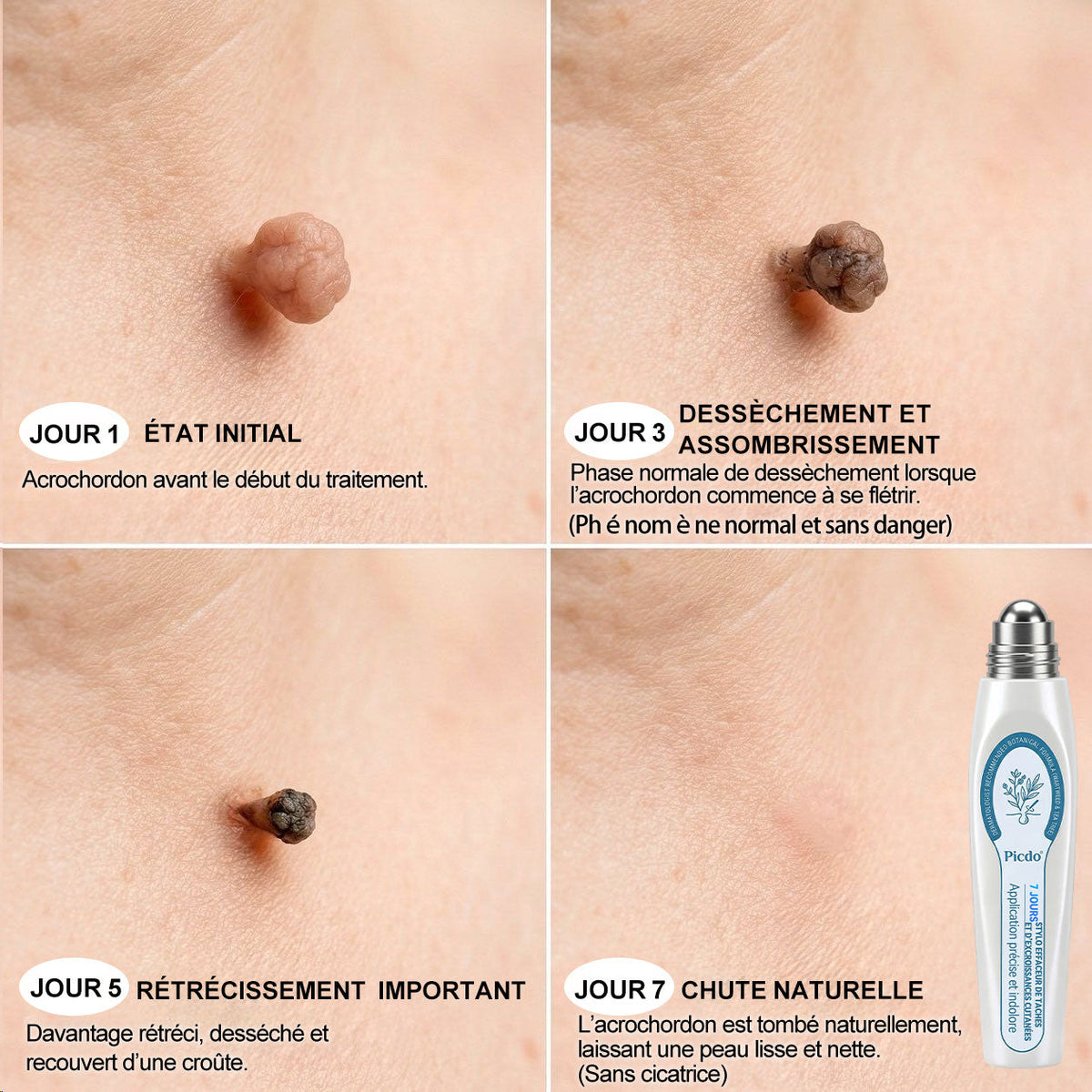 Boutique officielle de la marque |✅🎉𝐏i𝐜𝐝o® 7 Jours Effaceur de taches et d’excroissances cutanées(Zéro douleur, zéro cicatrice – Roller)