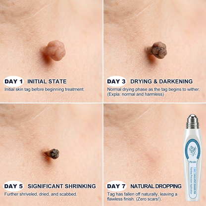 𝐏i𝐜𝐝o® 7-𝐷𝑎𝑦 𝗧𝐚𝐠 & 𝗦𝗽𝐨𝐭 𝐄𝐫𝒂𝒔𝒆𝒓(Zero Pain, Zero 𝐒𝐜𝐚𝒓𝒔 Rollerball)✅🚀